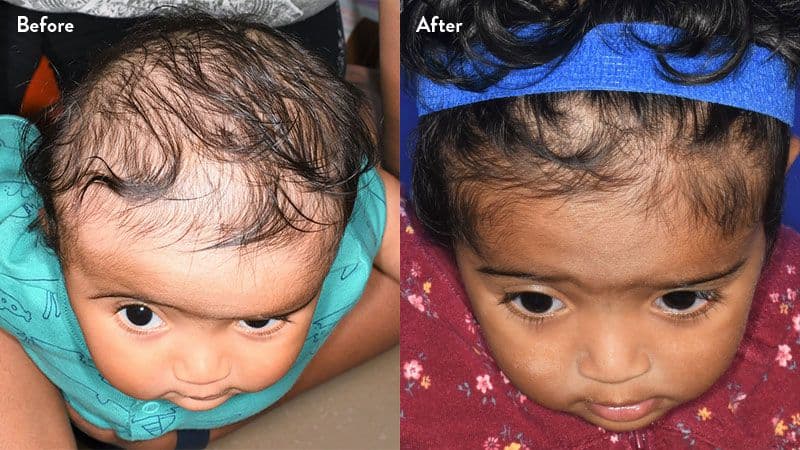 What Are the Signs and Treatments of Craniosynostosis?