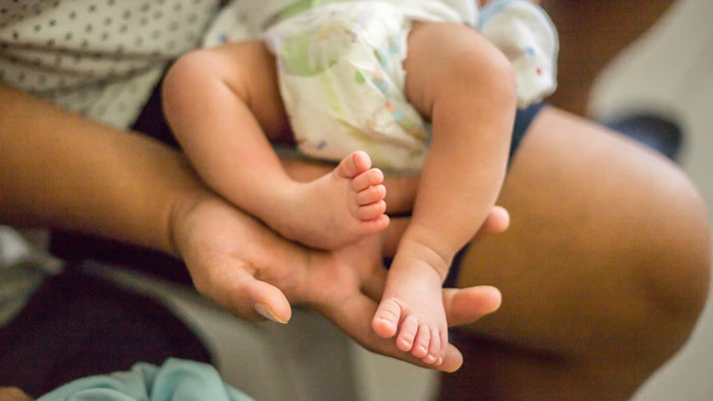 Understanding Clubfoot: Causes, Diagnosis, and Effective Treatment Approaches