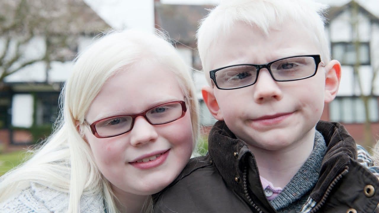 What Is Albinism and How Is It Inherited?