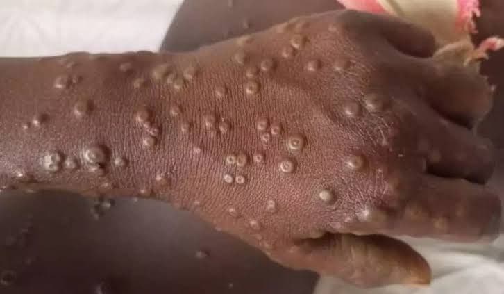  Kenya Confirms 314 Mpox Cases, 5 Deaths as Outbreak Spreads to 22 Counties